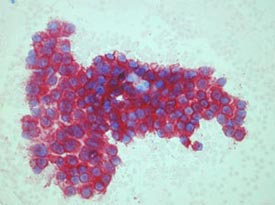 Nachweis von Thyreoglobulin in der Metastase eines papillären Schilddrüsenkarzinoms